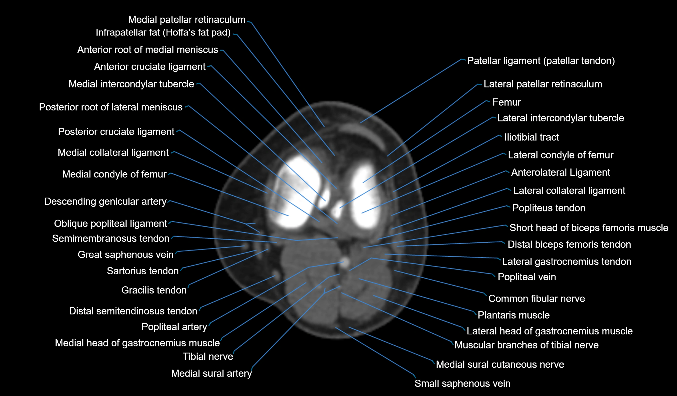 CT knee axial cross sectional anatomy labelled image-00035.webp